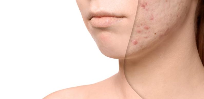How to treat acne scars according to the top specialists?
