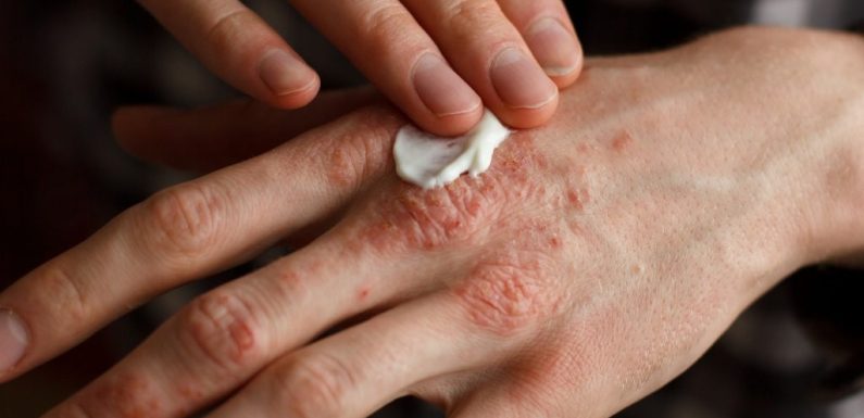 Treatment For Psoriasis