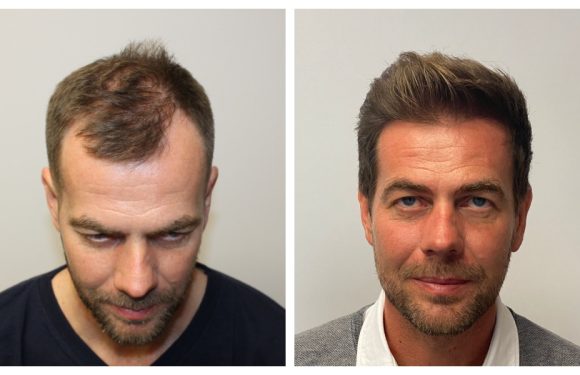 Why More Men Are Travelling To Turkey For Hair Transplants?