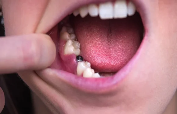 The Role Of Bite Distribution In Protecting Implants And Natural Teeth