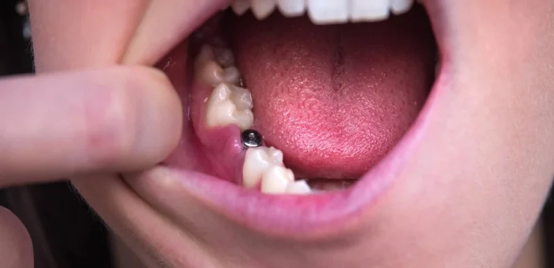 The Role Of Bite Distribution In Protecting Implants And Natural Teeth